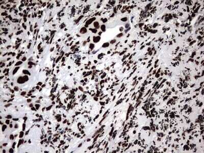 Immunohistochemistry: hnRNP M Antibody (OTI4C9) - Azide and BSA Free [NBP2-71200] - Analysis of Carcinoma of Human lung tissue. (Heat-induced epitope retrieval by 1 mM EDTA in 10mM Tris, pH8.5, 120C for 3min)