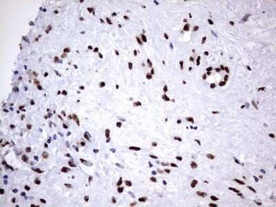 Immunohistochemistry: hnRNP M Antibody (OTI4C9) - Azide and BSA Free [NBP2-71200] - Analysis of Carcinoma of Human pancreas tissue. (Heat-induced epitope retrieval by 1 mM EDTA in 10mM Tris, pH8.5, 120C for 3min)