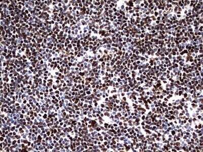 Immunohistochemistry: hnRNP M Antibody (OTI4C9) - Azide and BSA Free [NBP2-71200] - Analysis of Human lymphoma tissue. (Heat-induced epitope retrieval by 1 mM EDTA in 10mM Tris, pH8.5, 120C for 3min)