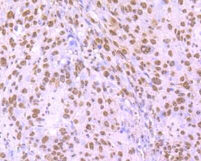 Immunohistochemistry-Paraffin: hnRNP U Antibody (JB23-43) [NBP2-75526] - Analysis of paraffin-embedded human lung cancer tissue using anti-HnRNP U antibody. Counter stained with hematoxylin.