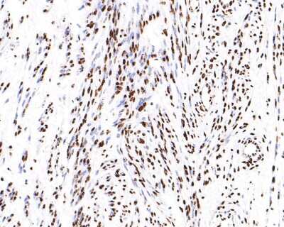 Immunohistochemistry-Paraffin: hnRNP U Antibody (JB23-43) [NBP2-75526] - Analysis of paraffin-embedded human cervix tissue with Rabbit anti-hnRNP U antibody washed with ddH2O and PBS, and then probed with the primary antibody  at 1/200 dilution for 1 hour at room temperature. The detection was performed using an HRP conjugated compact polymer system. DAB was used as the chromogen. Tissues were counterstained with hematoxylin and mounted with DPX.