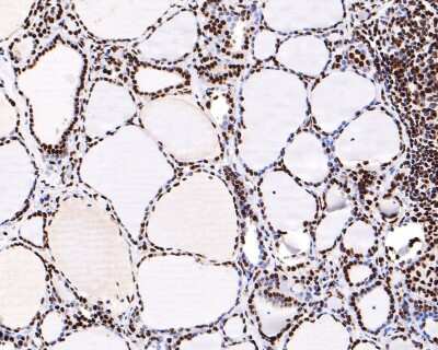 Immunohistochemistry-Paraffin: hnRNP U Antibody (JB23-43) [NBP2-75526] - Analysis of paraffin-embedded human thyroid tissue with Rabbit anti-hnRNP U antibody washed with ddH2O and PBS, and then probed with the primary antibody  at 1/200 dilution for 1 hour at room temperature. The detection was performed using an HRP conjugated compact polymer system. DAB was used as the chromogen. Tissues were counterstained with hematoxylin and mounted with DPX.