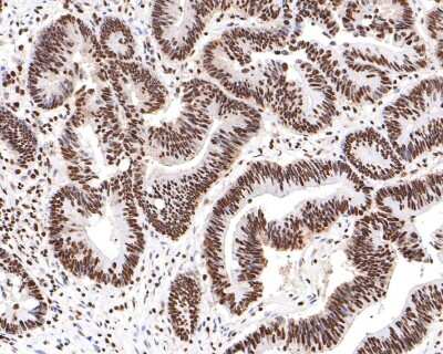 Immunohistochemistry-Paraffin: hnRNP U Antibody (JB23-43) [NBP2-75526] - Analysis of paraffin-embedded human colon carcinoma tissue with Rabbit anti-hnRNP U antibody washed with ddH2O and PBS, and then probed with the primary antibody  at 1/200 dilution for 1 hour at room temperature. The detection was performed using an HRP conjugated compact polymer system. DAB was used as the chromogen. Tissues were counterstained with hematoxylin and mounted with DPX.