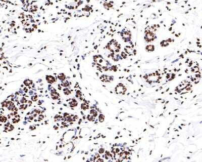 Immunohistochemistry-Paraffin: hnRNP U Antibody (JB23-43) [NBP2-75526] - Analysis of paraffin-embedded human breast tissue with Rabbit anti-hnRNP U antibody washed with ddH2O and PBS, and then probed with the primary antibody  at 1/200 dilution for 1 hour at room temperature. The detection was performed using an HRP conjugated compact polymer system. DAB was used as the chromogen. Tissues were counterstained with hematoxylin and mounted with DPX.