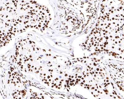 Immunohistochemistry-Paraffin: hnRNP U Antibody (JB23-43) [NBP2-75526] - Analysis of paraffin-embedded human breast carcinoma tissue with Rabbit anti-hnRNP U antibody washed with ddH2O and PBS, and then probed with the primary antibody  at 1/200 dilution for 1 hour at room temperature. The detection was performed using an HRP conjugated compact polymer system. DAB was used as the chromogen. Tissues were counterstained with hematoxylin and mounted with DPX.