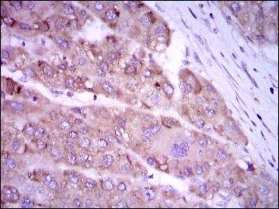 Immunohistochemistry-Paraffin: iNOS Antibody (4E5) [NBP2-22119] - Analysis of paraffin-embedded liver cancer tissues using iNOS mouse mAb with DAB staining.