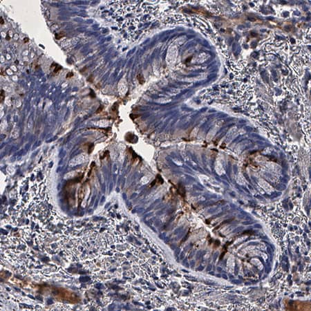 Spike RBD was detected in immersion fixed paraffin-embedded sections of Human lung infected with SARS delta variant using Llama Anti-SARS-CoV-2 Spike RBD LlamabodyTM VHH His-tag Monoclonal Antibody (Catalog # LMAB10869) at 1 &micro;g/mL overnight at 4 &deg;C. Tissue was stained using anti-Llama secondaries with HRP and counterstained with hematoxylin (blue). Specific staining was localized to cytoplasm in bronchial epithelial cells. View our protocol for IHC Staining with VisUCyte HRP Polymer Detection Reagents.