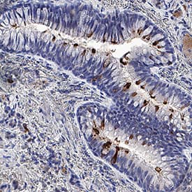 Spike RBD was detected in immersion fixed paraffin-embedded sections of Human lung infected with SARS delta variant using Llama Anti-SARS-CoV-2 Spike RBD LlaMABodyTM VHH His-tag Monoclonal Antibody (Catalog # LMAB12503) at 15 &micro;g/mL overnight at 4 &deg;C. Tissue was stained using anti-Llama secondaries with HRP and counterstained with hematoxylin (blue). Specific staining was localized to cytoplasm in bronchial epithelial cells. View our protocol for IHC Staining with VisUCyte HRP Polymer Detection Reagents.