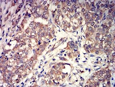 Immunohistochemistry: mGluR3 Antibody (6H10C3) [NBP2-61842] - Analysis of paraffin-embedded bladder cancer tissues using GRM3 mouse mAb with DAB staining.