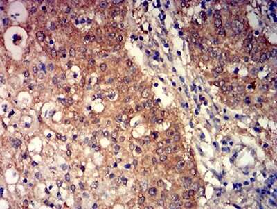 Immunohistochemistry: mGluR3 Antibody (6H10C3) [NBP2-61842] - Analysis of paraffin-embedded stomach cancer tissues using GRM3 mouse mAb with DAB staining.