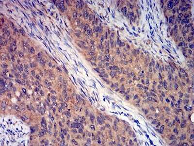 Immunohistochemistry-Paraffin: mGluR3 Antibody (7A5A6) [NBP2-61843] - Analysis of cervical cancer tissues using GRM3 mouse mAb with DAB staining.