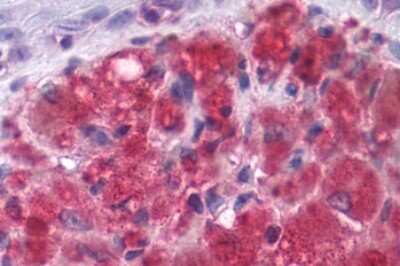 Immunohistochemistry-Paraffin: mGluR3 Antibody [NLS3218] - Anti-GRM3 / MGLUR3 antibody IHC of human Skin, Melanoma. Immunohistochemistry of formalin-fixed, paraffin-embedded tissue after heat-induced antigen retrieval.