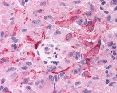 Immunohistochemistry-Paraffin: mGluR3 Antibody [NLS899] - Analysis of anti-GRM3 / MGLUR3 antibody with human brain, glioblastoma.