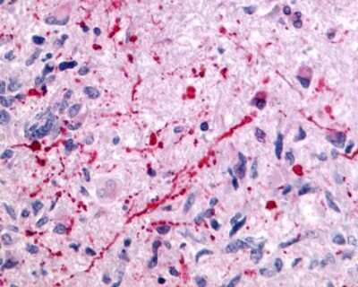 Immunohistochemistry-Paraffin: mGluR5 Antibody [NLS885] - Analysis of anti-GRM5 / MGLUR5 antibody with human brain, glioblastoma.