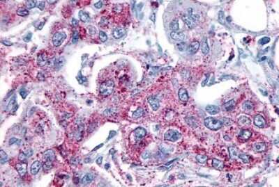 Immunohistochemistry-Paraffin: mGluR8 Antibody [NLS923] - Anti-GRM8 / MGLUR8 antibody IHC of human Pancreas, Carcinoma. Immunohistochemistry of formalin-fixed, paraffin-embedded tissue after heat-induced antigen retrieval.