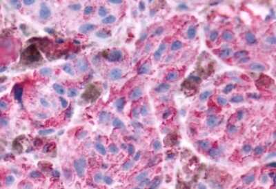 Immunohistochemistry-Paraffin: mGluR8 Antibody [NLS923] - Anti-GRM8 / MGLUR8 antibody IHC of human Skin, Melanoma. Immunohistochemistry of formalin-fixed, paraffin-embedded tissue after heat-induced antigen retrieval.