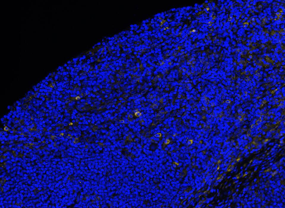 CD33 was detected in immersion fixed paraffin-embedded sections of human Hodgkin Lymphoma using Mouse Anti-Human CD33, Monoclonal Antibody (Catalog # MAB11371) at 15ug/mL at 37 ° Celsius for 4 minutes. Before incubation with the primary antibody, tissue underwent an all-in-one dewaxing and antigen retrieval preprocessing using PreTreatment Module (PT Module) and Dewax and HIER Buffer H (pH 9; Epredia Catalog # TA-999-DHBH). Tissue was stained using the Alexa Fluor™ 647 Goat anti-Mouse IgG Secondary Antibody at 1:200 at 37 ° Celsius for 2 minutes. (Yellow; Lunaphore Catalog # <A class=