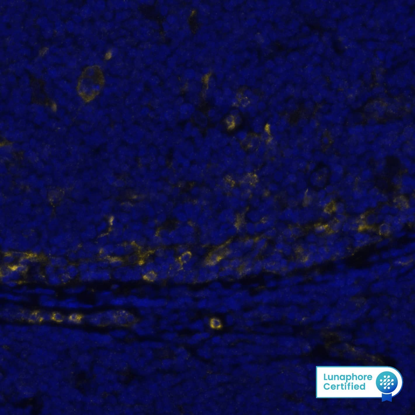 VISTA was detected in immersion fixed paraffin-embedded sections of human Mantle Cell Lymphoma using Rabbit Anti-Human VISTA, Monoclonal Antibody (Catalog # MAB11712) at 5ug/mL at 27° Celsius for 2 minutes. Before incubation with the primary antibody, tissue underwent an all-in-one dewaxing and antigen retrieval preprocessing using PreTreatment Module (PT Module) and Dewax and HIER Buffer H (pH 9; Epredia Catalog # TA-999-DHBH). Tissue was stained using the Alexa Fluor™ Plus 647 Goat anti-Rabbit IgG Secondary Antibody at 1:200 at 37 ° Celsius for 2 minutes. (Yellow; Lunaphore Catalog # DR647RB) and counterstained with DAPI (blue; Lunaphore Catalog # DR100). Specific staining was localized to the membrane and cytoplasm. Protocol available in COMET™ Panel Builder.