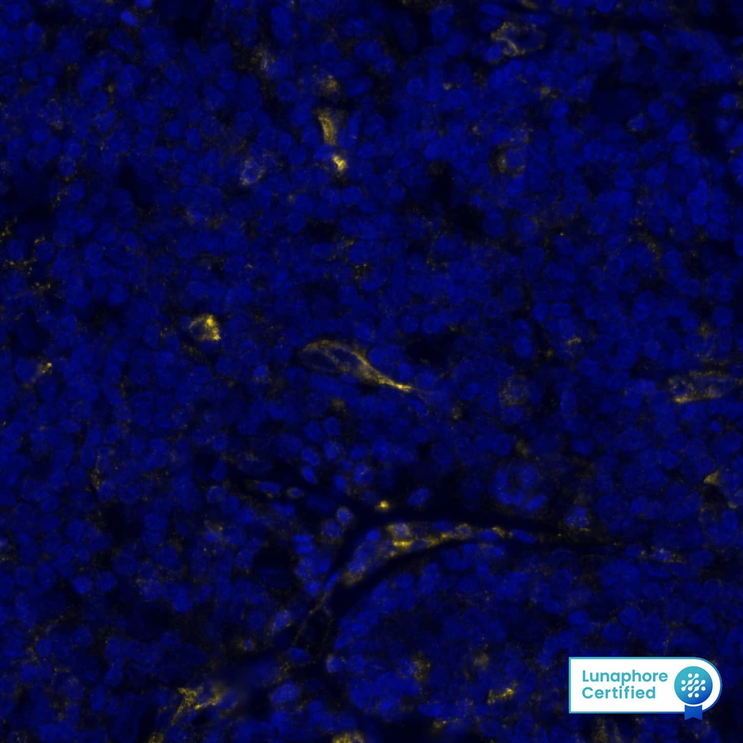 VISTA was detected in immersion fixed paraffin-embedded sections of human Hodgkin's Lymphoma using Rabbit Anti-Human VISTA, Monoclonal Antibody (Catalog # MAB11712) at 5ug/mL at 27° Celsius for 2 minutes. Before incubation with the primary antibody, tissue underwent an all-in-one dewaxing and antigen retrieval preprocessing using PreTreatment Module (PT Module) and Dewax and HIER Buffer H (pH 9; Epredia Catalog # TA-999-DHBH). Tissue was stained using the Alexa Fluor™ Plus 647 Goat anti-Rabbit IgG Secondary Antibody at 1:200 at 37 ° Celsius for 2 minutes. (Yellow; Lunaphore Catalog # DR647RB) and counterstained with DAPI (blue; Lunaphore Catalog # DR100). Specific staining was localized to the membrane and cytoplasm. Protocol available in COMET™ Panel Builder.