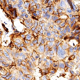 B7‑H3 was detected in immersion fixed paraffin-embedded sections of human liver cancer using Rabbit Anti-Human B7‑H3 Monoclonal Antibody (Catalog # MAB11721) at 0.5 µg/ml for 1 hour at room temperature followed by incubation with the Anti-Rabbit IgG VisUCyte™ HRP Polymer Antibody (Catalog # VC003) or the HRP-conjugated Anti-Rabbit IgG Secondary Antibody (Catalog # HAF008). Before incubation with the primary antibody, tissue was subjected to heat-induced epitope retrieval using VisUCyte Antigen Retrieval Reagent-Basic (Catalog # VCTS021). Tissue was stained using DAB (brown) and counterstained with hematoxylin (blue). Specific staining was localized to the membrane. View our protocol for IHC Staining with VisUCyte HRP Polymer Detection Reagents.