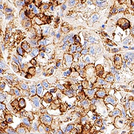 B7‑H3 was detected in immersion fixed paraffin-embedded sections of human lung cancer using Rabbit Anti-Human B7‑H3 Monoclonal Antibody (Catalog # MAB11721) at 0.5 µg/ml for 1 hour at room temperature followed by incubation with the Anti-Rabbit IgG VisUCyte™ HRP Polymer Antibody (Catalog # VC003) or the HRP-conjugated Anti-Rabbit IgG Secondary Antibody (Catalog # HAF008). Before incubation with the primary antibody, tissue was subjected to heat-induced epitope retrieval using VisUCyte Antigen Retrieval Reagent-Basic (Catalog # VCTS021). Tissue was stained using DAB (brown) and counterstained with hematoxylin (blue). Specific staining was localized to the membrane. View our protocol for IHC Staining with VisUCyte HRP Polymer Detection Reagents.