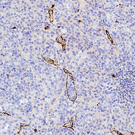 VE‑Cadherin was detected in immersion fixed paraffin-embedded sections of human prostate cancer using Rabbit Anti-Human VE‑Cadherin Monoclonal Antibody (Catalog # MAB11726) at 0.5 µg/ml for 1 hour at room temperature followed by incubation with the Anti-Rabbit IgG VisUCyte™ HRP Polymer Antibody (Catalog # VC003) or the HRP-conjugated Anti-Rabbit IgG Secondary Antibody (Catalog # HAF008). Before incubation with the primary antibody, tissue was subjected to heat-induced epitope retrieval using VisUCyte Antigen Retrieval Reagent-Basic (Catalog # VCTS021). Tissue was stained using DAB (brown) and counterstained with hematoxylin (blue). Specific staining was localized to the membrane. View our protocol for IHC Staining with VisUCyte HRP Polymer Detection Reagents.