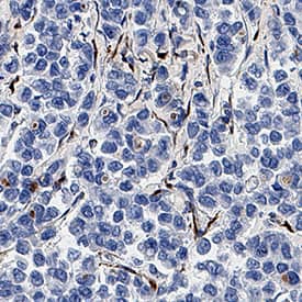 Collagen I  alpha 1 was detected in immersion fixed paraffin-embedded sections of human breast tumor using Rabbit Anti-Human Collagen I  alpha 1 Monoclonal Antibody (Catalog # MAB11757) at 3 µg/ml overnight at 4 °C. Before incubation with the primary antibody, tissue was subjected to heat-induced epitope retrieval using VisUCyte Antigen Retrieval Reagent-Basic (Catalog # VCTS021). Tissue was stained using the HRP-conjugated Anti-Rabbit IgG Secondary Antibody (Catalog # HAF008) and counterstained with hematoxylin (blue). Specific staining was localized to the cytoplasm. View our protocol for Chromogenic IHC Staining of Paraffin-embedded Tissue Sections.