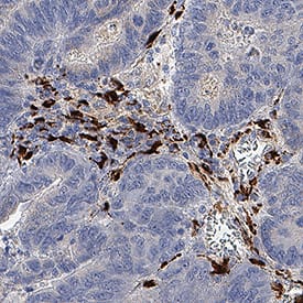 Collagen I  alpha 1 was detected in immersion fixed paraffin-embedded sections of human colon cancer using Rabbit Anti-Human Collagen I  alpha 1 Monoclonal Antibody (Catalog # MAB11757) at 3 µg/ml overnight at 4 °C. Before incubation with the primary antibody, tissue was subjected to heat-induced epitope retrieval using VisUCyte Antigen Retrieval Reagent-Basic (Catalog # VCTS021). Tissue was stained using the HRP-conjugated Anti-Rabbit IgG Secondary Antibody (Catalog # HAF008) and counterstained with hematoxylin (blue). Specific staining was localized to the cytoplasm. View our protocol for Chromogenic IHC Staining of Paraffin-embedded Tissue Sections.