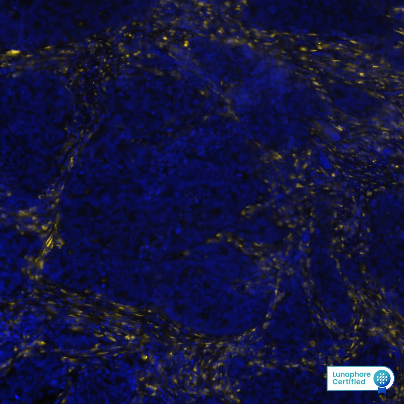 Col1A1 was detected in immersion fixed paraffin-embedded sections of human Colon Cancer using Rabbit Anti-Human Col1A1, Monoclonal Antibody (Catalog # MAB) at 20ug/mL at 37° Celsius for 4 minutes. Before incubation with the primary antibody, tissue underwent an all-in-one dewaxing and antigen retrieval preprocessing using PreTreatment Module (PT Module) and Dewax and HIER Buffer H (pH 9; Epredia Catalog # TA-999-DHBH). Tissue was stained using the Alexa Fluor™ Plus 647 Goat anti-Rabbit IgG Secondary Antibody at 1:200 at 37 ° Celsius for 2 minutes. (Yellow; Lunaphore Catalog # DR647RB) and counterstained with DAPI (blue; Lunaphore Catalog # DR100). Specific staining was localized to the cytoplasm. Protocol available in COMET™ Panel Builder.