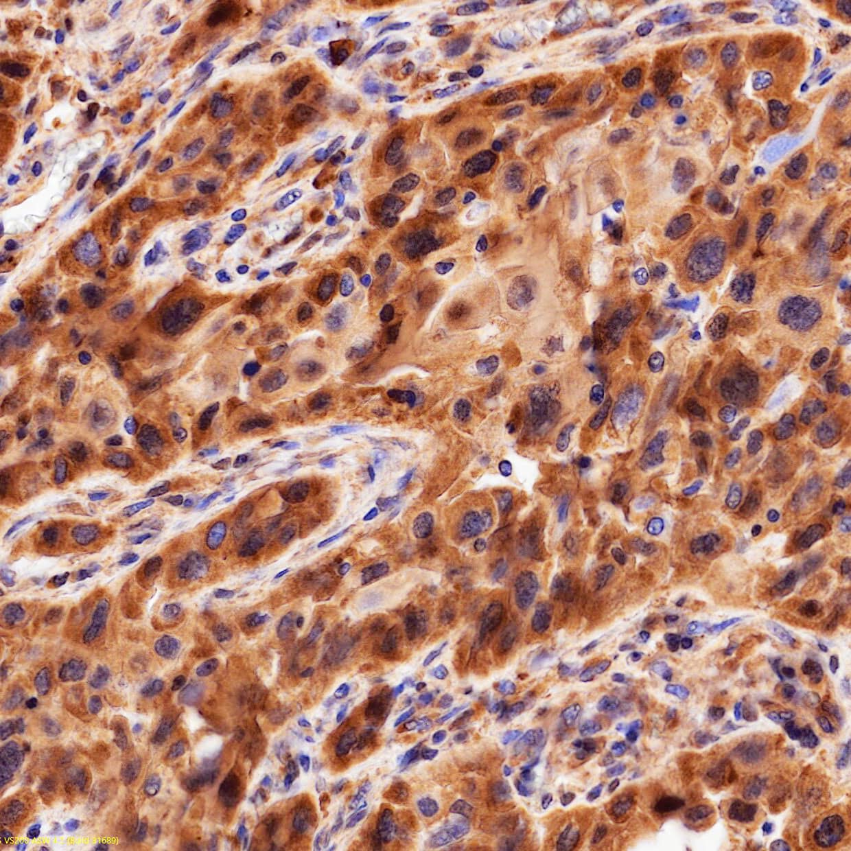 HSPA8/HSC71 was detected in immersion fixed paraffin-embedded sections of human lung using Rabbit Anti-Human HSPA8/HSC71 Monoclonal Antibody (Catalog # MAB11819) at 1 µg/ml overnight at 4 &deg;C. Before incubation with the primary antibody, tissue was subjected to heat-induced epitope retrieval using VisUCyte Antigen Retrieval Reagent-Basic (<a class=