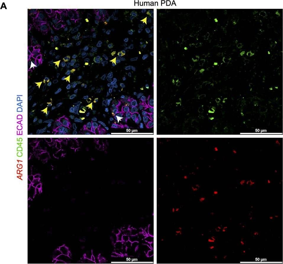 Arginase 1 (Arg1) is highly expressed in human&mouse myeloid cells.(A) Representative image of RNA in situ hybridization (ISH) of ARG1 (red)&co-immunofluorescence staining of immune (CD45, green)&epithelial (E-cadherin [ECAD], magenta) cells in human pancreatic ductal adenocarcinoma (PDA). Counterstain, DAPI (blue). White arrows point to ARG1-ISH in ECAD+ cells,&yellow arrows point to ARG1-ISH in CD45+ cells. Scale bar, 50 μm. Image collected & cropped by CiteAb from the following open publication (//pubmed.ncbi.nlm.nih.gov/36727849), licensed under a CC-BY license. Not internally tested by R&D Systems.