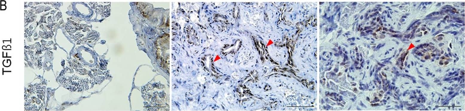 Expression of genes involved in fibrosis at 6 months.(A) IHC and ISH (inlets) showing MMP9 expression in proliferating myofibroblasts and ductular cells. (B) IHC for TGF beta 1. Contrary to MMP9, TGF beta 1 is expressed only in proliferating ductular cells which are also positive for cytokeratin. (C, D) ISH for PDGFAa and IL1b. Transcripts of both genes are detected in a small subset of proliferating myofibroblasts and ductular cells. (A–C, red arrowheads, ductular cells). Microscopic images are 400×. Bars, 50 µm. Image collected and cropped by CiteAb from the following open publication (//pubmed.ncbi.nlm.nih.gov/22164219), licensed under a CC-BY license. Not internally tested by R&D Systems.