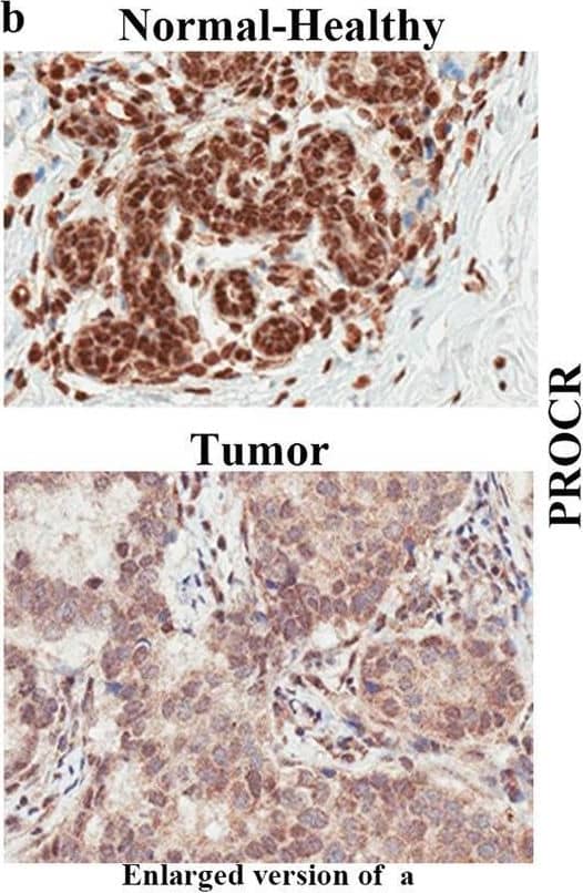 PROCR expression pattern in Normal-Healthy, NATs, and breast tumors. A Representative IHC of PROCR in Normal-Healthy, NATs, and/or tumors of women of AA and EA. b Enlarged view of PROCR expression in Normal-Healthy and tumor. c Differences in PROCR expression (positivity and H-score) between Normal-Healthy tissues of women of AA and EA. Differences in PROCR expression (positivity *p = 2.2051E−8 and H-score *p = 6.0538E−9) between Normal-Healthy tissues of AA and EA. The statistical test that was utilized to analyze the data was two-sided Wilcoxon Test. d Differences in PROCR expression (positivity and H-score) between Normal-Healthy and NATs of women of AA and EA (positivity *p = 4.588E−11 and H-score *p = 1.4572E−11). The data were analyzed using two-sided Wilcoxon test. e Differences in PROCR expression (positivity and H-score) between NATs and tumors of women of AA and EA. Data were analyzed using two-sided Wilcoxon test. (Normal-Healthy-AA (n = 31), and EA (n = 129); NAT -AA (n = 35) and EA (n = 31); Tumor -AA (n = 41) and EA (n = 62)). Depending on availability, two cores of same NAT and tumor were included in the TMA. Dot blots in this and subsequent relevant figures include values from both cores of the same sample. All the data points are shown as mean ± SD. Source data are provided as a Source Data file. Image collected and cropped by CiteAb from the following open publication (//pubmed.ncbi.nlm.nih.gov/37709737), licensed under a CC-BY license. Not internally tested by R&D Systems.