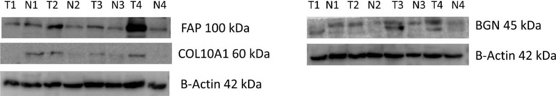 The expression levels of hub genes in GC. (A) The mRNA expression was correlated with pathological T stages. The asterisk represents the comparison between a specific stage and the normal group, or between different stages. * p < 0.05, ** p < 0.01, *** p < 0.001. (B) Representative western blotting for COL10A1, BGN, and FAP proteins in 4 paired gastric tumor (T) and adjacent non-tumor tissues (N) with progressive stages from T1 to T4. Image collected and cropped by CiteAb from the following open publication (//pubmed.ncbi.nlm.nih.gov/35328635), licensed under a CC-BY license. Not internally tested by R&D Systems.