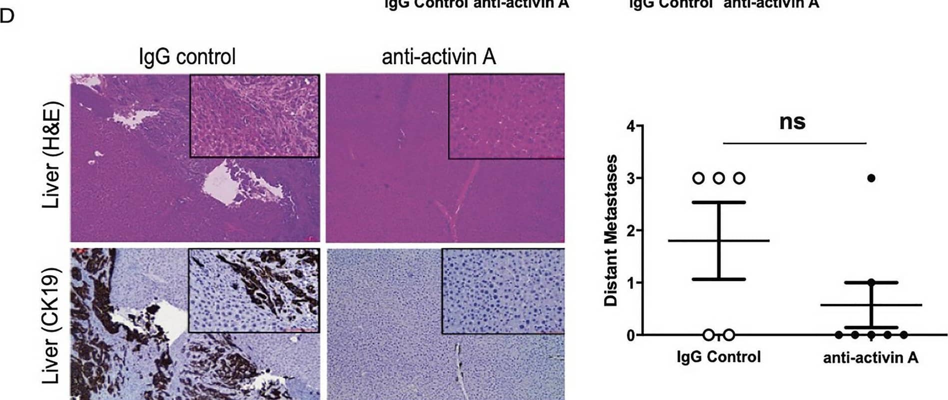 Inhibition of activin A in KPC mice significantly reduces metastasis. (A) Time course of anti-activin A neutralizing antibody injected in mice weekly (2 mg/kg). Control animals were injected with the same concentration of IgG isotype. Remaining animals were collected at the end of week 13 of treatment. (B) Representative image (×4 magnification) of H&E staining of pancreas from control treated (IgG) and anti-activin A treated KPC mice IHC-stained for either  alpha -SMA (to indicate stromal cells) or activin A. Representative stromal cells marked by arrows. (C) Representative image (×4 magnification) of H&E staining of pancreas used for quantification of CN (yellow arrow) cystic lesions. Quantification of lesions is documented in both IgG control and anti-activin A antibody treated mice. (D) Left panel: Representative images (×10 and ×40 magnification) of liver tissue from control treated versus anti-activin A treated KPC mice stained with H&E (upper panel) or ductal marker protein CK19 (Lower panel). Right panel: Quantification of distant metastatic formation in the liver tissue of control (n = 5) and treated (n = 7) mice. Statistical analysis unpaired Student t-test (ns: not significant). Image collected and cropped by CiteAb from the following open publication (//pubmed.ncbi.nlm.nih.gov/33846512), licensed under a CC-BY license. Not internally tested by R&D Systems.