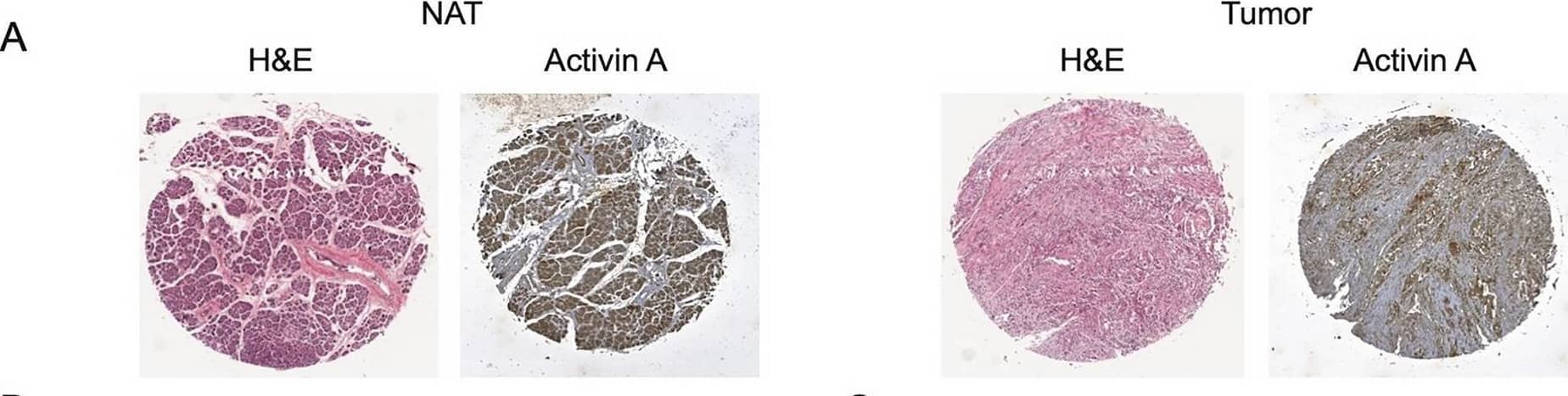 Activin A levels are significantly higher in tumor tissue and correlate to worse prognosis in PDAC. (A) Representative cores of pancreatic tumors from a human pancreatic tissue microarray stained with H&E to assess the percentage of epithelial versus stromal cells in each core. Adjacent sections were immunostained for activin A expression. (B) Quantification of the percentage of epithelial cells (left panel) or stromal cells (right panel) in normal tissue (white bar) versus tumor tissue (black bar). Statistical analysis is unpaired t-test. (C) Quantification of activin A in TMA (n = 63). An average of the percentage of epithelial and stromal fraction was calculated and scored in each TMA. Comparing epithelial (left panel) and stromal fraction (right panel) in normal tissue (white bar) versus tumor tissue (black bar). Statistical analysis 2-way ANOVA; mean ± SEM, ***(p < 0.001). (D) Kaplan–Meier plots of patient overall survival versus expression of activin A in either epithelial cells (left panel) or stromal cells (right panel). Statistical analysis Log-rank (Mantel-Cox) test, ** (p < 0.01), ***(p < 0.001). Image collected and cropped by CiteAb from the following open publication (//pubmed.ncbi.nlm.nih.gov/33846512), licensed under a CC-BY license. Not internally tested by R&D Systems.
