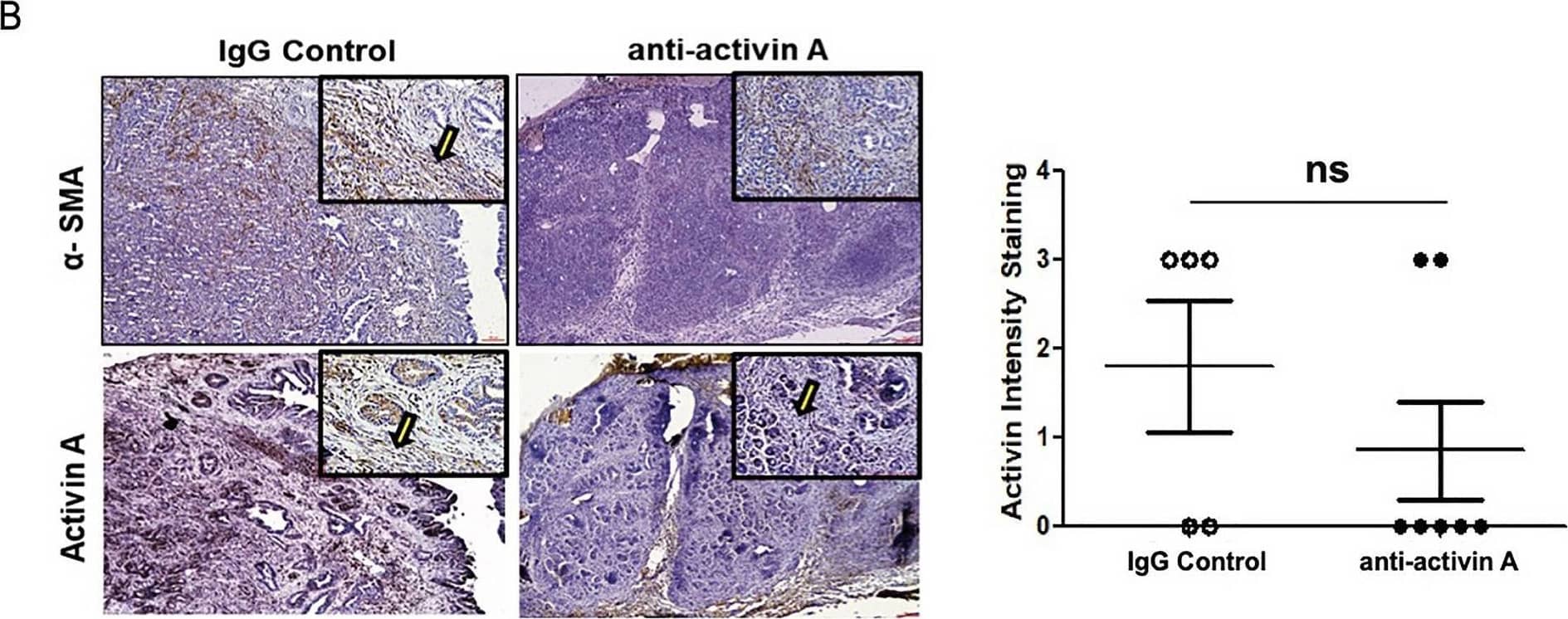 Inhibition of activin A in KPC mice significantly reduces metastasis. (A) Time course of anti-activin A neutralizing antibody injected in mice weekly (2 mg/kg). Control animals were injected with the same concentration of IgG isotype. Remaining animals were collected at the end of week 13 of treatment. (B) Representative image (×4 magnification) of H&E staining of pancreas from control treated (IgG) and anti-activin A treated KPC mice IHC-stained for either  alpha -SMA (to indicate stromal cells) or activin A. Representative stromal cells marked by arrows. (C) Representative image (×4 magnification) of H&E staining of pancreas used for quantification of CN (yellow arrow) cystic lesions. Quantification of lesions is documented in both IgG control and anti-activin A antibody treated mice. (D) Left panel: Representative images (×10 and ×40 magnification) of liver tissue from control treated versus anti-activin A treated KPC mice stained with H&E (upper panel) or ductal marker protein CK19 (Lower panel). Right panel: Quantification of distant metastatic formation in the liver tissue of control (n = 5) and treated (n = 7) mice. Statistical analysis unpaired Student t-test (ns: not significant). Image collected and cropped by CiteAb from the following open publication (//pubmed.ncbi.nlm.nih.gov/33846512), licensed under a CC-BY license. Not internally tested by R&D Systems.
