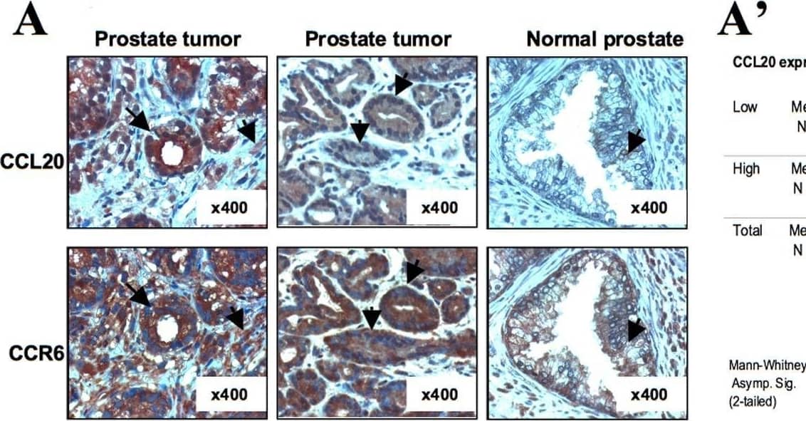 CCL20, CCR6 and CXCR4 expression in prostate cancer cell lines, in primary prostate tumor tissue and in normal prostate tissue.(A) Expression of CCL20 and CCR6 in human prostate cancer tissue and in human normal prostate tissue. Immunohistostaining of prostate cancer and normal specimens using the polyclonal antibody for CCL20 and the monoclonal antibody 140706 for CCR6. Original magnification of ×400 is shown. CCL20 and CCR6 expression was observed in endothelial and fibromuscular cells of prostate samples (signed with black arrows). A commercially available array including 52 samples (CA2) from patients with prostate cancer was stained for CCL20 (A′) and CCR6 (A″). Expression was scored on two levels: low or negative expression, and high expression. Statistical analysis of the immunohistochemical staining was performed using two-tailed Mann-Whitney test. (B) Common expression pattern of CCL20 and CXCR4 in human prostate cancer. Immunohistostaining of prostate cancer specimens using the polyclonal antibody for CCL20 and the monoclonal antibody 12G5 for CXCR4. Original magnification of ×400 is shown. CCL20 and CXCR4 expression was observed in endothelial and fibromuscular cells of prostate samples. (B′) A commercially available array including 48 samples (CA3) from patients with prostate cancer was stained for CCL20 and CXCR4. Expression was scored on three levels: low, intermediate, and high expression. Samples that demonstrated the same scoring in CCL20 and CXCR4 expression levels were classified as having similar expression pattern. Samples where scores in CCL20 and CXCR4 expression differed in one level or more were classified as different expression patterns. Image collected and cropped by CiteAb from the following open publication (//pubmed.ncbi.nlm.nih.gov/19340288), licensed under a CC-BY license. Not internally tested by R&D Systems.