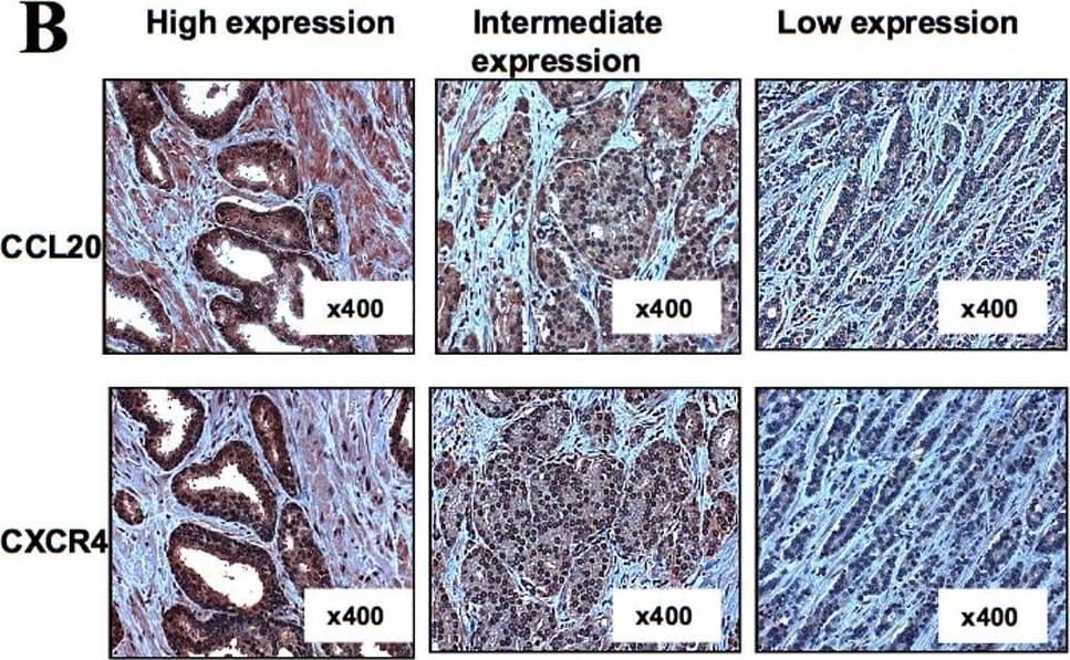 CCL20, CCR6 and CXCR4 expression in prostate cancer cell lines, in primary prostate tumor tissue and in normal prostate tissue.(A) Expression of CCL20 and CCR6 in human prostate cancer tissue and in human normal prostate tissue. Immunohistostaining of prostate cancer and normal specimens using the polyclonal antibody for CCL20 and the monoclonal antibody 140706 for CCR6. Original magnification of ×400 is shown. CCL20 and CCR6 expression was observed in endothelial and fibromuscular cells of prostate samples (signed with black arrows). A commercially available array including 52 samples (CA2) from patients with prostate cancer was stained for CCL20 (A′) and CCR6 (A″). Expression was scored on two levels: low or negative expression, and high expression. Statistical analysis of the immunohistochemical staining was performed using two-tailed Mann-Whitney test. (B) Common expression pattern of CCL20 and CXCR4 in human prostate cancer. Immunohistostaining of prostate cancer specimens using the polyclonal antibody for CCL20 and the monoclonal antibody 12G5 for CXCR4. Original magnification of ×400 is shown. CCL20 and CXCR4 expression was observed in endothelial and fibromuscular cells of prostate samples. (B′) A commercially available array including 48 samples (CA3) from patients with prostate cancer was stained for CCL20 and CXCR4. Expression was scored on three levels: low, intermediate, and high expression. Samples that demonstrated the same scoring in CCL20 and CXCR4 expression levels were classified as having similar expression pattern. Samples where scores in CCL20 and CXCR4 expression differed in one level or more were classified as different expression patterns. Image collected and cropped by CiteAb from the following open publication (//pubmed.ncbi.nlm.nih.gov/19340288), licensed under a CC-BY license. Not internally tested by R&D Systems.