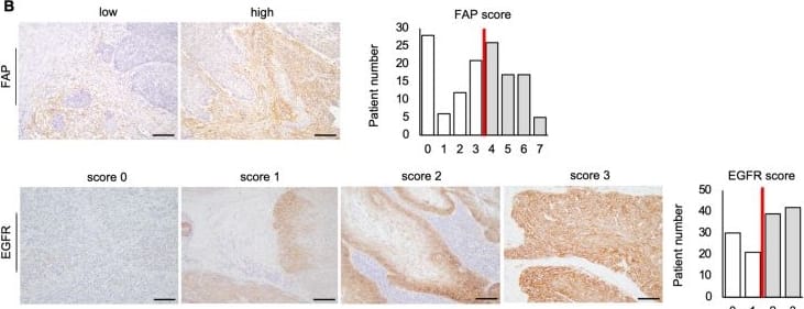 The expression of FAP and EGFR and clinical outcome in 132 cases of esophageal cancer. (A) IHC for FAP and EGFR are shown at low and high magnification (40 × and 200 ×). Scale bars: 500 µm (40 ×), 100 µm (200 ×). The expression of FAP and EGFR is different between intra-tumoral and peri-tumoral tissue. (B) Representative example of a low- and high-FAP and EGFR case. Scale bars: 200 µm (100 ×). The FAP score of 4 + or more were defined as high, that of 3 + or less were low; the EGFR expression level of 2 + or 3 + were defined as high, that of 0 or 1 + were low. (C) Survival analysis showed that FAP high patients had significantly worse OS than those with low FAP (P < 0.001, log-rank test; *P < 0.05). (D) Patients with high EGFR tended to show poorer OS than those with low EGFR (P = 0.074, log-rank test). (E) Survival curve of three groups divided by combination of EGFR and FAP scores (double negative, single positive, double positive), double positive group had worse survival than others (P = 0.005: vs. double negative, P = 0.089: vs. single positive, log-rank test; *P < 0.05). Image collected and cropped by CiteAb from the following open publication (//pubmed.ncbi.nlm.nih.gov/36418422), licensed under a CC-BY license. Not internally tested by R&D Systems.