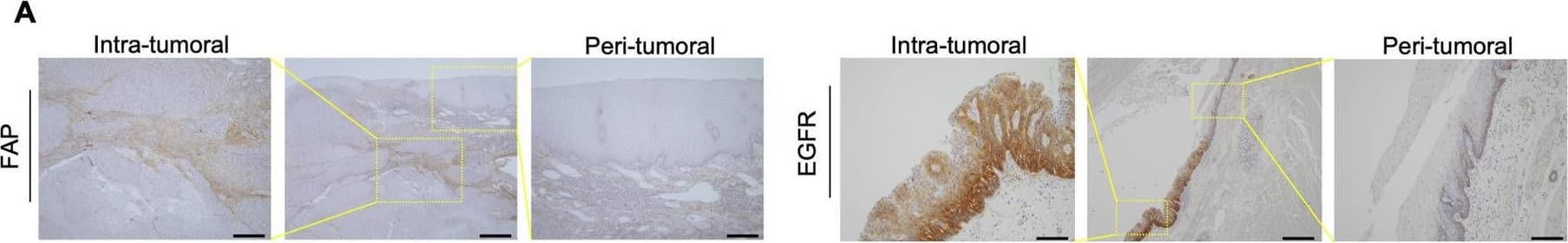 The expression of FAP and EGFR and clinical outcome in 132 cases of esophageal cancer. (A) IHC for FAP and EGFR are shown at low and high magnification (40 × and 200 ×). Scale bars: 500 µm (40 ×), 100 µm (200 ×). The expression of FAP and EGFR is different between intra-tumoral and peri-tumoral tissue. (B) Representative example of a low- and high-FAP and EGFR case. Scale bars: 200 µm (100 ×). The FAP score of 4 + or more were defined as high, that of 3 + or less were low; the EGFR expression level of 2 + or 3 + were defined as high, that of 0 or 1 + were low. (C) Survival analysis showed that FAP high patients had significantly worse OS than those with low FAP (P < 0.001, log-rank test; *P < 0.05). (D) Patients with high EGFR tended to show poorer OS than those with low EGFR (P = 0.074, log-rank test). (E) Survival curve of three groups divided by combination of EGFR and FAP scores (double negative, single positive, double positive), double positive group had worse survival than others (P = 0.005: vs. double negative, P = 0.089: vs. single positive, log-rank test; *P < 0.05). Image collected and cropped by CiteAb from the following open publication (//pubmed.ncbi.nlm.nih.gov/36418422), licensed under a CC-BY license. Not internally tested by R&D Systems.