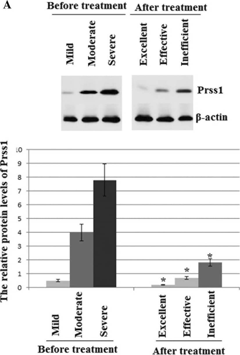 Protein expression levels of (A) PRSS1 and (B) SPINK1 in AP patients before and after treatment. Patients were divided into three groups based on the severity of their AP; mild, modest and severe. Out of a total of 50 AP patients that underwent ITCM therapy, 26 exhibited mild AP (light grey), 13 exhibited modest AP (medium grey) and 11 patients were diagnosed with severe AP (dark grey). Following ITCM treatment, 29 patients exhibited excellent therapeutic results (26 mild, two modest and one severe), 17 patients exhibited an effective outcome (11 modest and six severe) and four severe patients showed an ineffective response. Data are represented as the mean ± standard deviation of three independent experiments. *P<0.01, vs. value before treatment. AP, acute pancreatitis; ITCM, integrated traditional Chinese medicine. Image collected and cropped by CiteAb from the following open publication (//pubmed.ncbi.nlm.nih.gov/25667658), licensed under a CC-BY license. Not internally tested by R&D Systems.