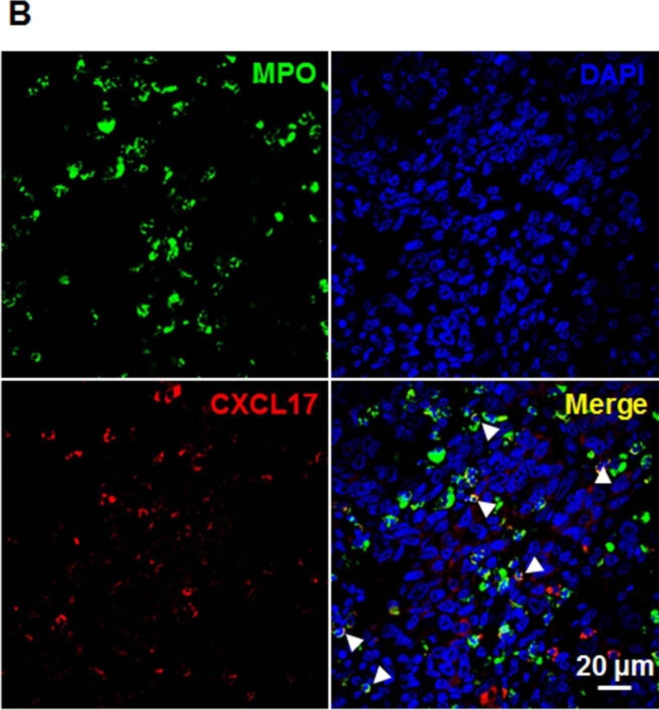CXCL17 expression in situ in HCC tumors.(A) Representative sites depicting CXCL17-producing cells stained brown in human chronic hepatitis liver, nontumor, peritumoral stroma, and intratumoral regions in HCC. Representative sites with low (upper panels) and high (lower panels) magnification were shown. Black arrows indicated CXCL17+ cells. (B) Multiple staining of MPO (green), CXCL17 (red), and DAPI (blue, nuclei) in paraffin-embedded sections analyzed by confocal microscopy. The coexistence of MPO and CXCL17 confirmed that a proportion of MPO+ neutrophils expressed CXCL17. White arrows indicated representative neutrophils expressed CXCL17. (C) Proportions of CXCL17+MPO+ cells in CXCL17+ cells or MPO+ cells of HCC tissue. Results are expressed as mean ± SEM (bars). Image collected and cropped by CiteAb from the following open publication (//pubmed.ncbi.nlm.nih.gov/25303284), licensed under a CC-BY license. Not internally tested by R&D Systems.