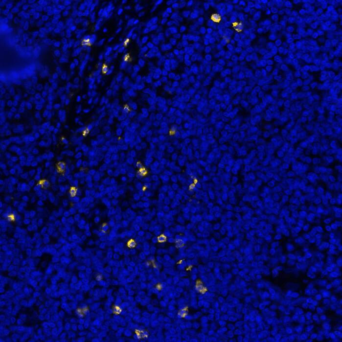 CEACAM-8 was detected in immersion fixed paraffin-embedded sections of human Hodgkin Lymphoma using Mouse Anti-Human CEACAM-8, Monoclonal Antibody (Catalog #MAB4246) at 1ug/mL at 37° Celsius for 4 minutes. Before incubation with the primary antibody, tissue underwent an all-in-one dewaxing and antigen retrieval preprocessing using PreTreatment Module (PT Module)and Dewax and HIER Buffer H (pH 9; Epredia Catalog #TA-999-DHBH). Tissue was stained using the Alexa Fluor™ 647 Goat anti-Mouse IgG Secondary Antibody at 1:200 at 37 ° Celsius for 2 minutes. (Yellow; Lunaphore Catalog # DR647MS) and counterstained with DAPI (blue; Lunaphore Catalog # DR100). Specific staining was localized to the membrane. Protocol available in COMET™ Panel Builder.​