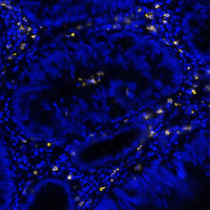 CEACAM-8 was detected in immersion fixed paraffin-embedded sections of human colon cancer using Mouse Anti-Human CEACAM-8, Monoclonal Antibody (Catalog #MAB4246) at 1ug/mL at 37° Celsius for 4 minutes. Before incubation with the primary antibody, tissue underwent an all-in-one dewaxing and antigen retrieval preprocessing using PreTreatment Module (PT Module)and Dewax and HIER Buffer H (pH 9; Epredia Catalog #TA-999-DHBH). Tissue was stained using the Alexa Fluor™ 647 Goat anti-Mouse IgG Secondary Antibody at 1:200 at 37 ° Celsius for 2 minutes. (Yellow; Lunaphore Catalog # DR647MS) and counterstained with DAPI (blue; Lunaphore Catalog # DR100). Specific staining was localized to the membrane. Protocol available in COMET™ Panel Builder.​