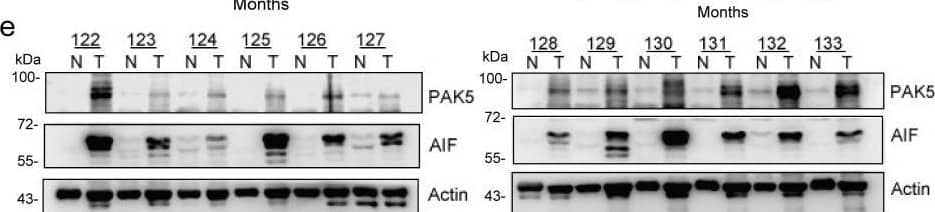  PAK5 & AIF expression positively correlated with poor prognosis of breast cancer. (a) Analysis of expression differential proteins regulated by PAK5. Lysates from MDA-MB-231  overexpressing Flag-vector or Flag-tagged PAK5 & screening of differentially expressed proteins by sequencing. (b) Predict the expression of AIF in breast cancer & adjacent cancer in TCGA database. The fold-change was 0.897. (c) Predict the overall survival of AIF in GSE31519 database. (d) Predict the overall survival of AIF in TCGA database. (e) PAK5 & AIF expression in 122 clinical breast tissue pairs. Lysates of tumor tissues (T) & matched adjacent noncancerous tissues (N) were analyzed using Western blotting. Twelve representative pairs are shown. (f) The indicated protein levels in (e) were statistically analyzed (****p < 0.001). (g) Spearman's rank test was used to analyze the correlation between AIF relative expression & PAK5 relative expression in 122 subjects. (h) Representative images of immunohistochemical staining showing PAK5 & AIF protein expression in breast cancer. Original magnification, 400×. IHC staining was scored, & a Pearson correlation test was performed. Note that the scores of some samples overlap. (i-l) Kaplan-Meier survival analysis (GraphPad) of the relationship between overall survival (upper) & disease-free survival (lower) in breast cancer cases & PAK5 and/or AIF expression. The subjects were divided into different groups based on indicated PAK5 & AIF expression scores in the tumors: PAK5 low (n = 35) & PAK5 high (n = 40, i); AIF low (n = 36) & AIF high (n = 39, j). n = 15 for PAK5 low/AIF low, n=4 for PAK5 high/AIF low, n=12 for PAK5 low/AIF high, n = 44 for PAK5 high/AIF high; n = 35 for high nuclear translocation ratio of AIF, n = 40 for low nuclear translocation ratio of AIF. Image collected & cropped by CiteAb from the following open publication (//pubmed.ncbi.nlm.nih.gov/33867848), licensed under a CC-BY license. Not internally tested by R&D Systems.