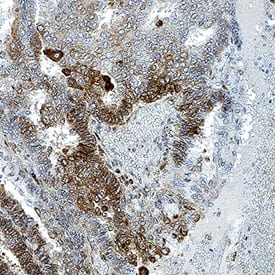 ISG15/UCRP was detected in immersion fixed paraffin-embedded sections of Human Endometrial Cancer using Mouse Anti-Human ISG15/UCRP Monoclonal Antibody (Catalog # MAB4845) at 0.5 &micro;g/mL for 1 hour at room temperature followed by incubation with the Anti-Mouse IgG VisUCyte&trade; HRP Polymer Antibody (Catalog # VC001). Before incubation with the primary antibody, tissue was subjected to heat-induced epitope retrieval using VisUCyte Antigen Retrieval Reagent-Basic (Catalog # VCTS021). Tissue was stained using DAB (brown) and counterstained with hematoxylin (blue). Specific staining was localized to cytoplasm in cancer cells. View our protocol for IHC Staining with VisUCyte HRP Polymer Detection Reagents.
