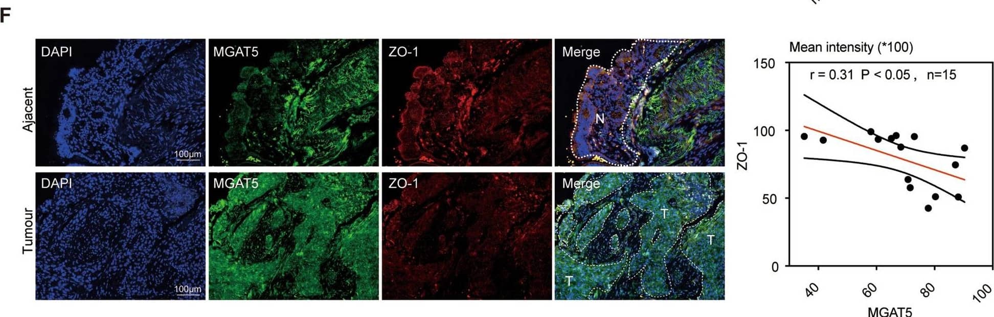 Clinical significance of MGAT5 as a potential therapeutic target in tumour EMT. A Representative IHC staining of MGAT5 in CRC patient tissue from the TMA (ZL-Cocsur1241). B MGAT5 protein expression in malignant colorectal cancer (T) and adjacent nonmalignant tissues (N). The data are presented as a box plot. Whiskers show the min-to-max values, n = 69 per group. C Kaplan‒Meier analysis of OS in patients with varying MGAT5 expression levels based on data from selected CRC tissues. D Kaplan‒Meier analyses were performed to assess the associations between MGAT5 expression and RFS. E MGAT5 protein levels in nonmetastatic and metastatic colorectal cancer (T) tissues. The data are presented as a box plot. The whiskers show the min-to-max values. F Immunostaining of the CRC tissue TMA for MGAT5 or ZO-1. Correlations between the mean MGAT5 intensity and the mean ZO-1 intensity in CRC tissue samples (n = 15). Pearson's correlation analysis yielded the R and p values. Scale bar: 100 µm Image collected and cropped by CiteAb from the following open publication (//pubmed.ncbi.nlm.nih.gov/39511539), licensed under a CC-BY license. Not internally tested by R&D Systems.