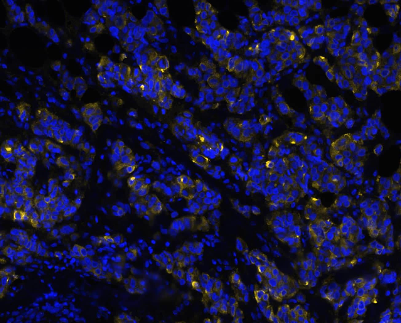 MUC1 was detected in immersion fixed paraffin-embedded sections of human breast tumor using Mouse Anti-Human MUC1, Monoclonal Antibody (Catalog # MAB6298) at 4ug/mL at 27 ° Celsius for 2 minutes. Before incubation with the primary antibody, tissue underwent an all-in-one dewaxing and antigen retrieval preprocessing using PreTreatment Module (PT Module) and Dewax and HIER Buffer H (pH 9; Epredia Catalog # TA-999-DHBH). Tissue was stained using the Alexa Fluor™ 647 Goat anti-Mouse IgG Secondary Antibody at 1:200 at 37 ° Celsius for 2 minutes. (Yellow; Lunaphore Catalog # DR647MS) and counterstained with DAPI (blue; Lunaphore Catalog # DR100). Specific staining was localized to the membrane. Protocol available in COMET™ Panel Builder.