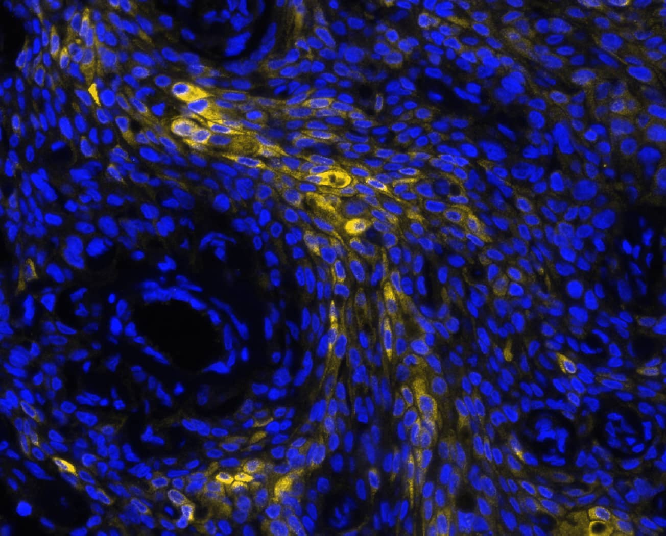 MUC1 was detected in immersion fixed paraffin-embedded sections of human pancreas tumor using Mouse Anti-Human MUC1, Monoclonal Antibody (Catalog # MAB6298) at 4ug/mL at 27 ° Celsius for 2 minutes. Before incubation with the primary antibody, tissue underwent an all-in-one dewaxing and antigen retrieval preprocessing using PreTreatment Module (PT Module) and Dewax and HIER Buffer H (pH 9; Epredia Catalog # TA-999-DHBH). Tissue was stained using the Alexa Fluor™ 647 Goat anti-Mouse IgG Secondary Antibody at 1:200 at 37 ° Celsius for 2 minutes. (Yellow; Lunaphore Catalog # DR647MS) and counterstained with DAPI (blue; Lunaphore Catalog # DR100). Specific staining was localized to the membrane. Protocol available in COMET™ Panel Builder.​